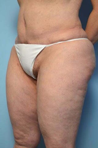 Liposuction Before & After Gallery - Patient 341886 - Image 8