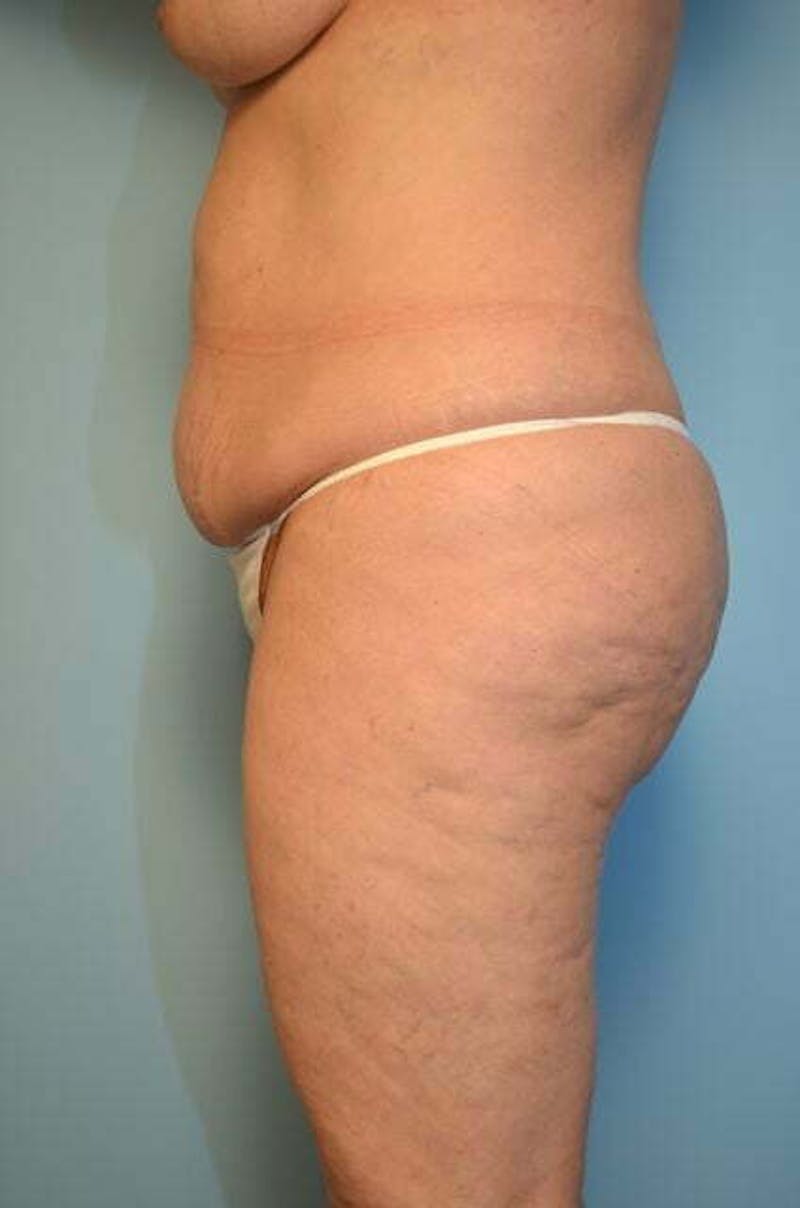 Liposuction Before & After Gallery - Patient 341886 - Image 9