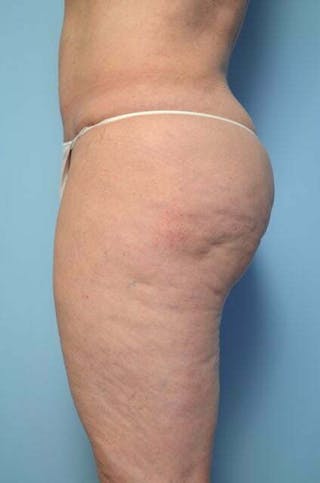 Liposuction Before & After Gallery - Patient 341886 - Image 10