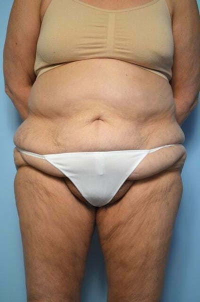 Liposuction Before & After Gallery - Patient 258736 - Image 1