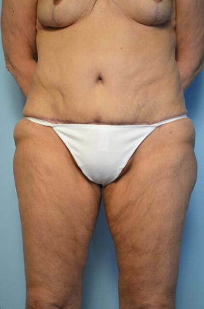 Liposuction Before & After Gallery - Patient 258736 - Image 2