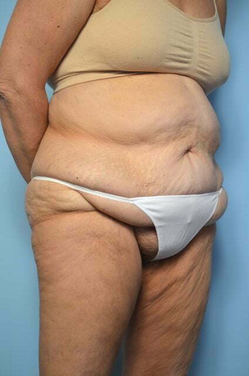 Liposuction Before & After Gallery - Patient 258736 - Image 3