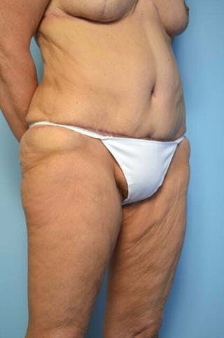 Liposuction Before & After Gallery - Patient 258736 - Image 4