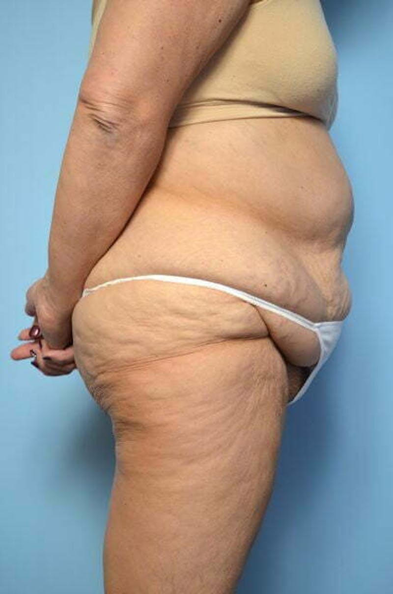 Liposuction Before & After Gallery - Patient 258736 - Image 5