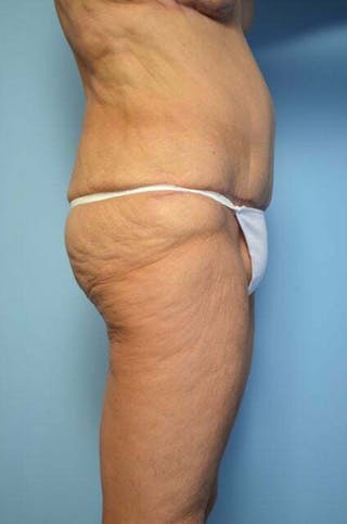 Liposuction Before & After Gallery - Patient 258736 - Image 6