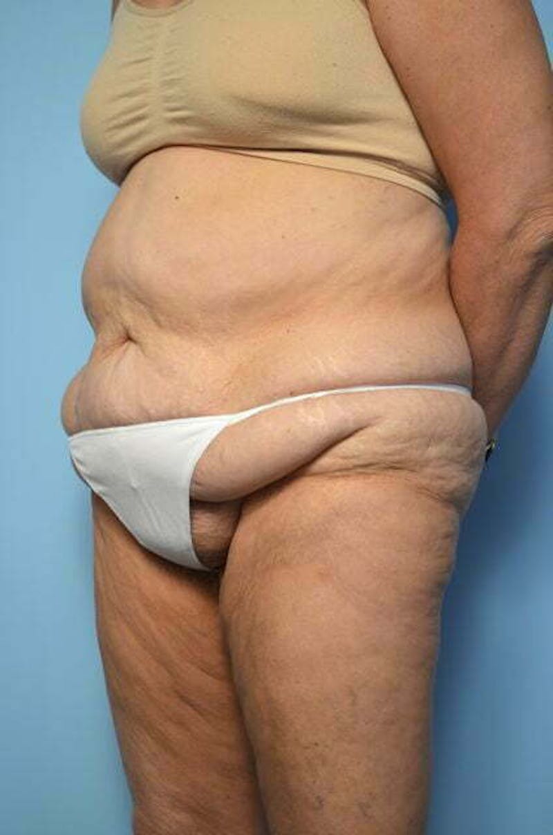 Liposuction Before & After Gallery - Patient 258736 - Image 7