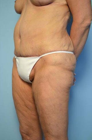 Liposuction Before & After Gallery - Patient 258736 - Image 8