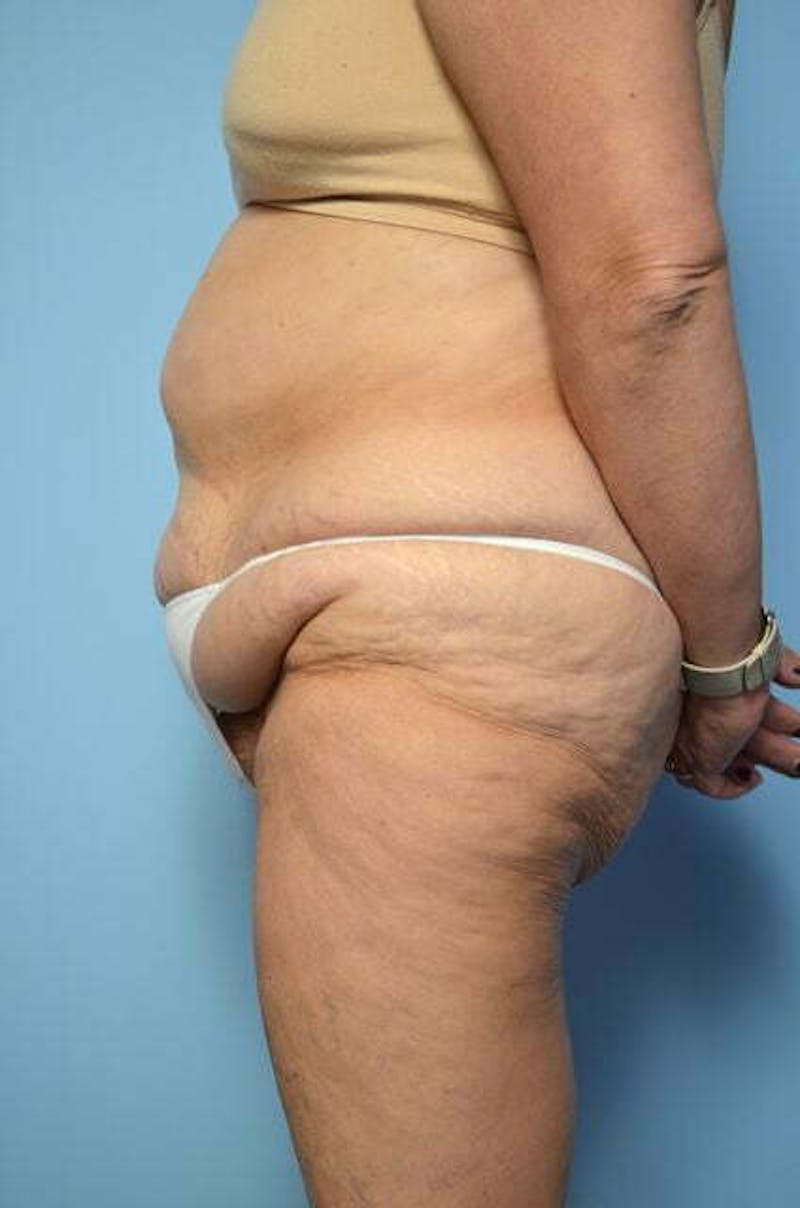 Liposuction Before & After Gallery - Patient 258736 - Image 9
