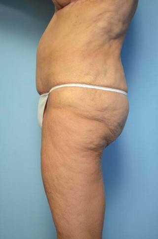 Liposuction Before & After Gallery - Patient 258736 - Image 10