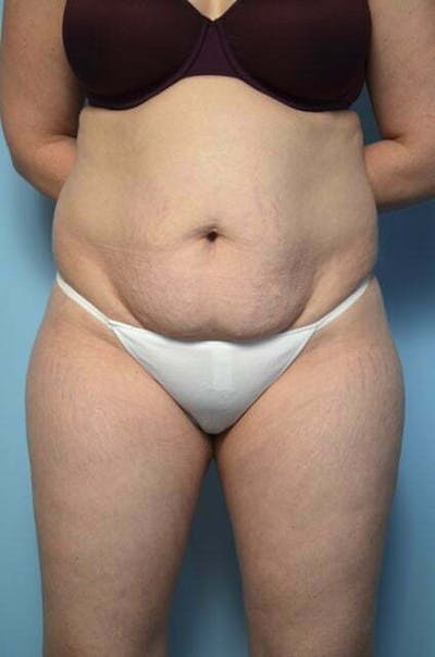 Liposuction Before & After Gallery - Patient 661218 - Image 1