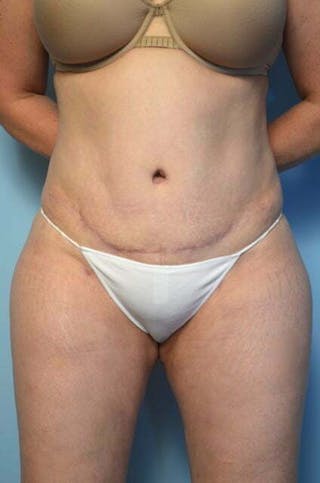 Tummy Tuck Before & After Gallery - Patient 258364 - Image 2