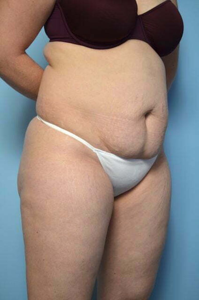 Tummy Tuck Before & After Gallery - Patient 258364 - Image 3