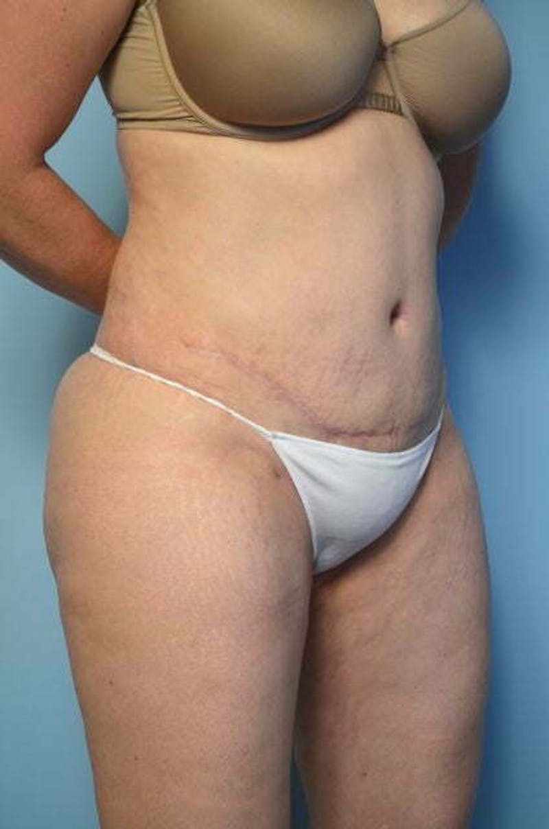 Tummy Tuck Before & After Gallery - Patient 258364 - Image 4