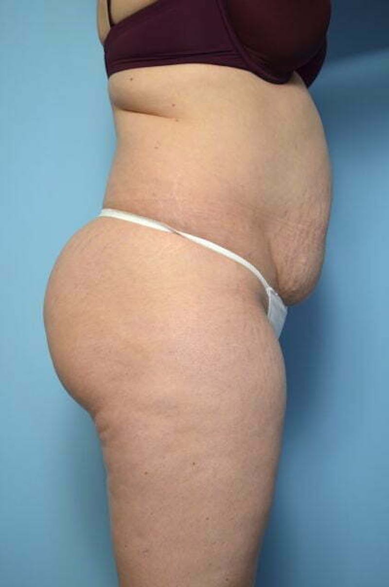 Tummy Tuck Before & After Gallery - Patient 258364 - Image 5