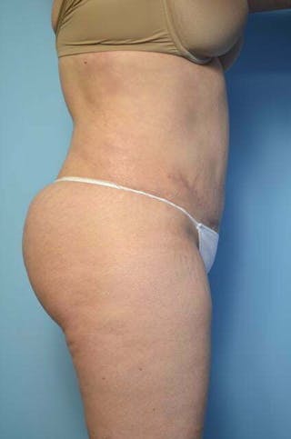 Tummy Tuck Before & After Gallery - Patient 258364 - Image 6