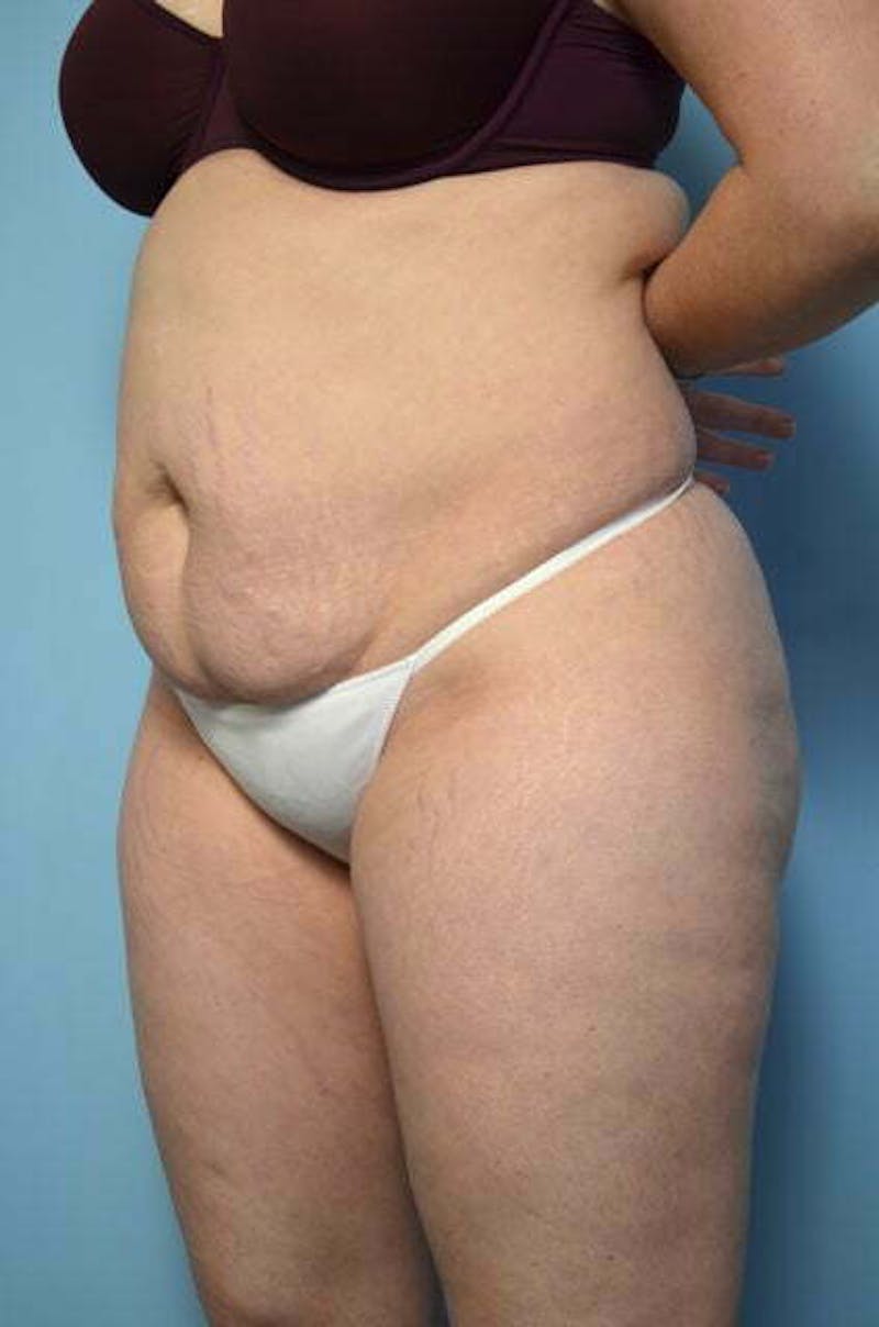 Tummy Tuck Before & After Gallery - Patient 258364 - Image 7