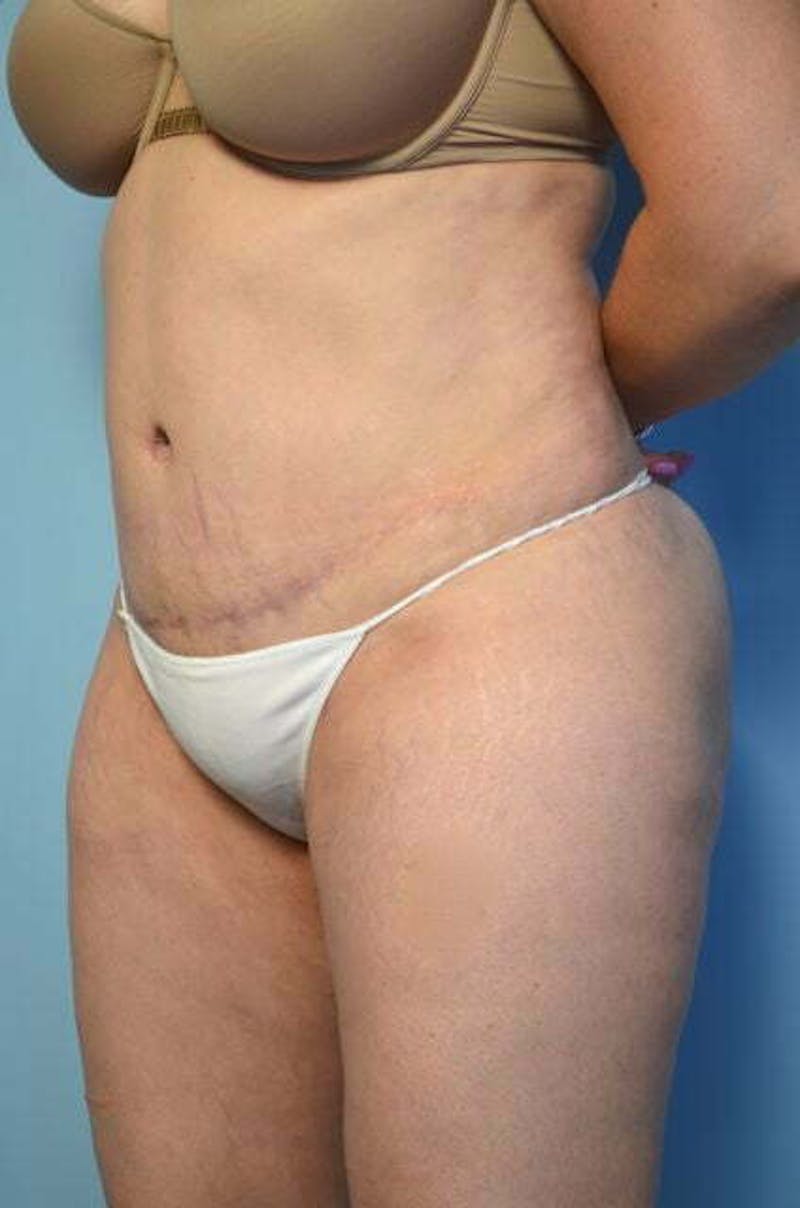 Tummy Tuck Before & After Gallery - Patient 258364 - Image 8
