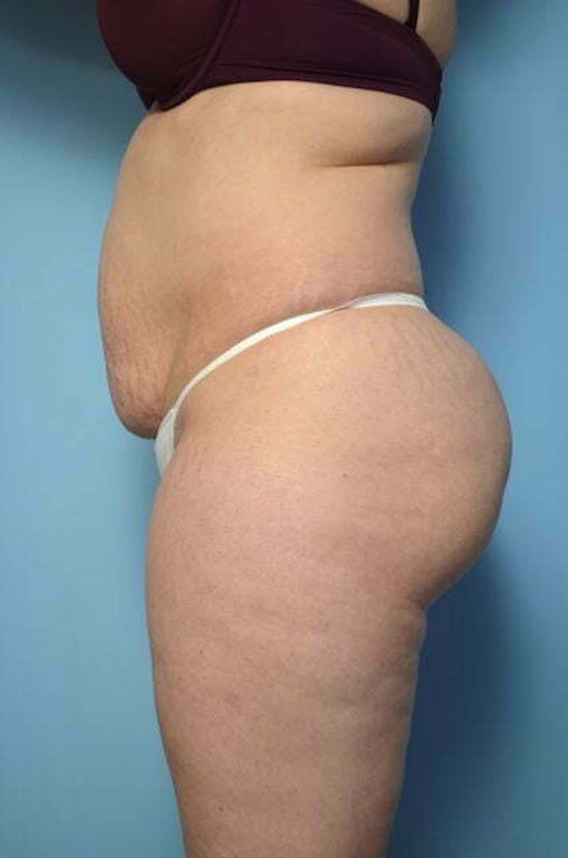 Tummy Tuck Before & After Gallery - Patient 258364 - Image 9