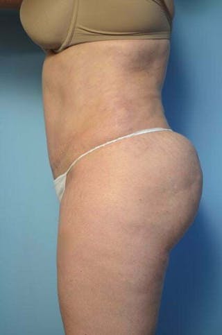 Tummy Tuck Before & After Gallery - Patient 258364 - Image 10