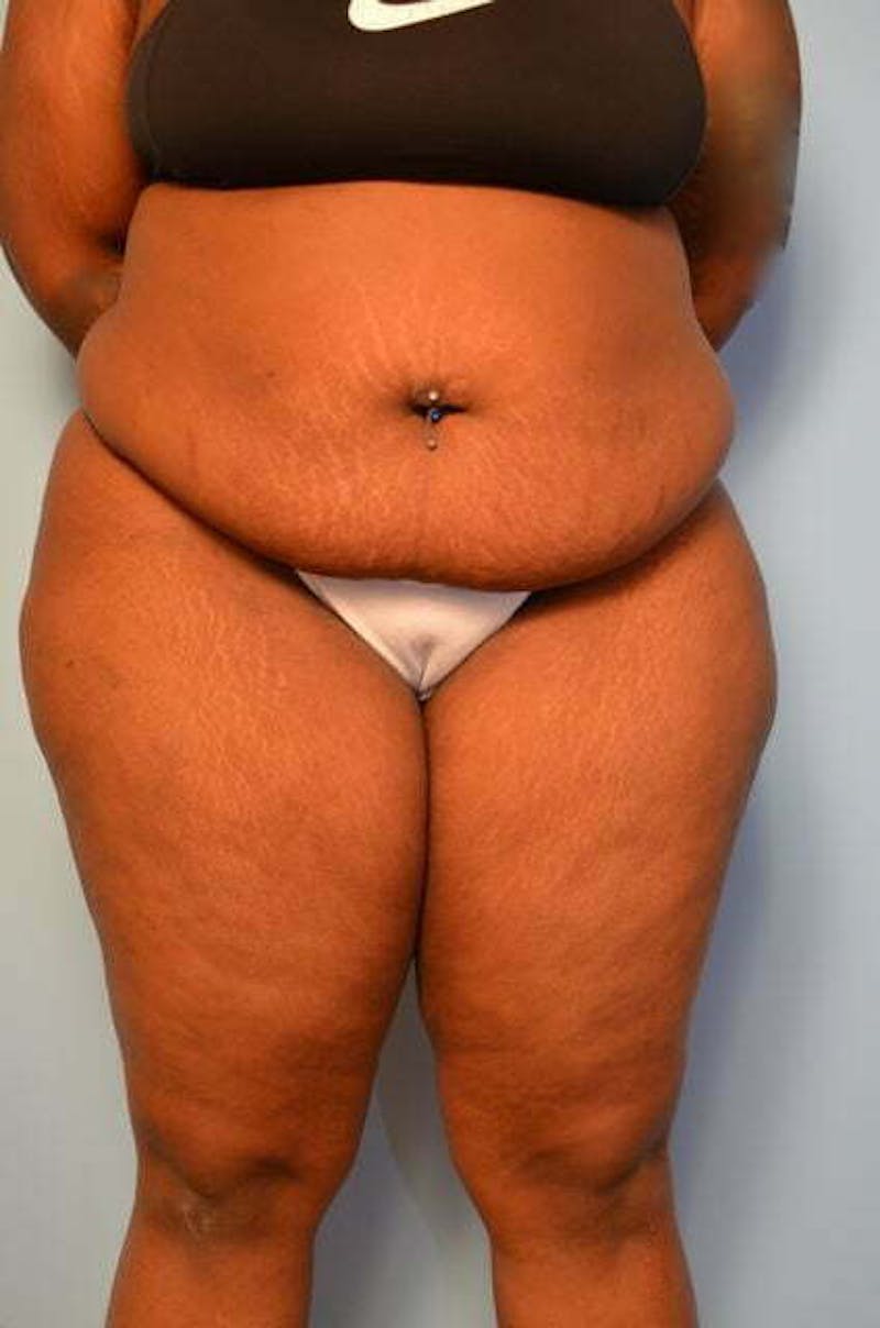 Tummy Tuck Before & After Gallery - Patient 309754 - Image 1