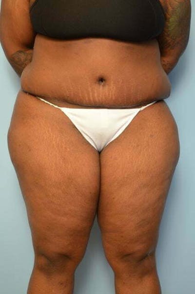 Tummy Tuck Before & After Gallery - Patient 309754 - Image 2