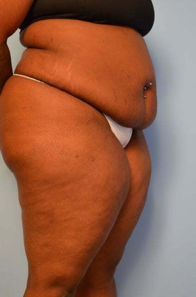 Tummy Tuck Before & After Gallery - Patient 309754 - Image 3