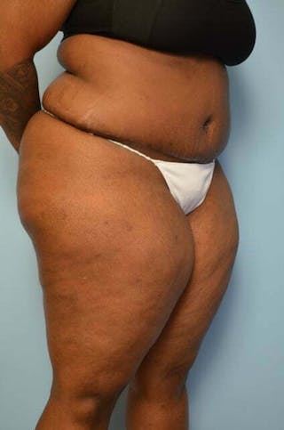 Tummy Tuck Before & After Gallery - Patient 309754 - Image 4