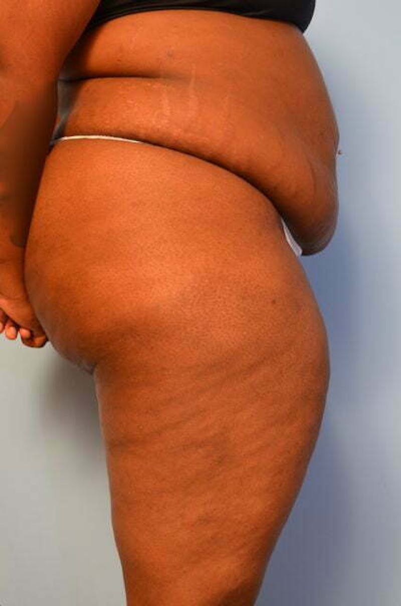 Tummy Tuck Before & After Gallery - Patient 309754 - Image 5