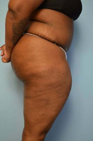 Tummy Tuck Before & After Gallery - Patient 309754 - Image 6