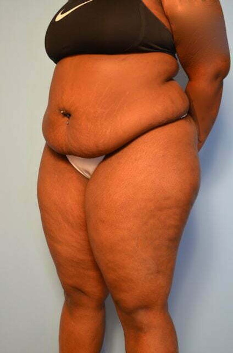 Tummy Tuck Before & After Gallery - Patient 309754 - Image 7