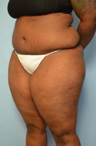 Tummy Tuck Before & After Gallery - Patient 309754 - Image 8