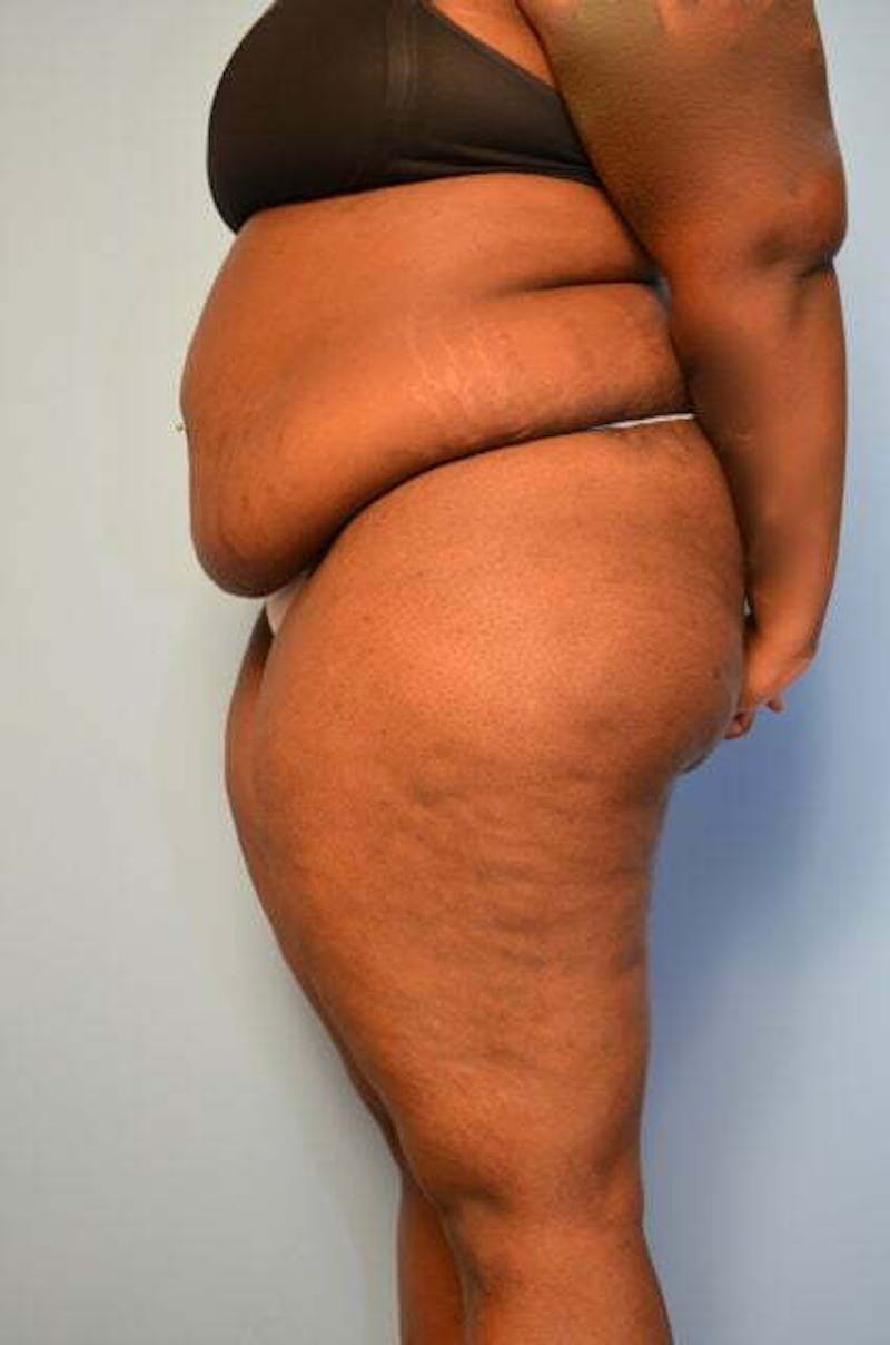 Tummy Tuck Before & After Gallery - Patient 309754 - Image 9