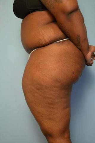 Tummy Tuck Before & After Gallery - Patient 309754 - Image 10