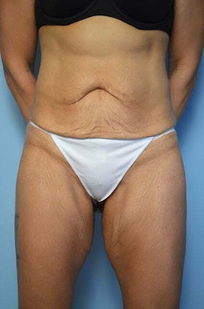 Tummy Tuck Before & After Gallery - Patient 358816 - Image 1