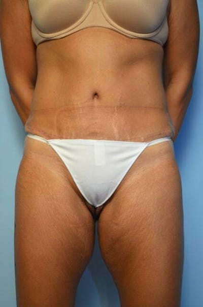 Tummy Tuck Before & After Gallery - Patient 358816 - Image 2