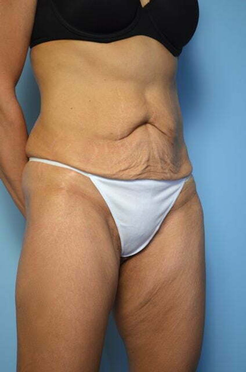 Tummy Tuck Before & After Gallery - Patient 358816 - Image 3
