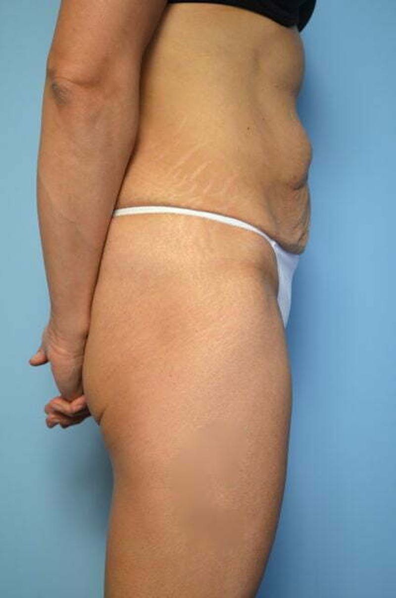 Tummy Tuck Before & After Gallery - Patient 358816 - Image 5