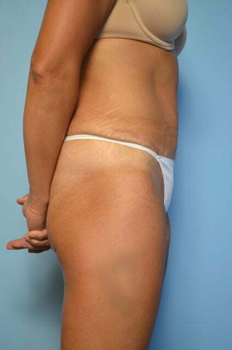 Tummy Tuck Before & After Gallery - Patient 358816 - Image 6