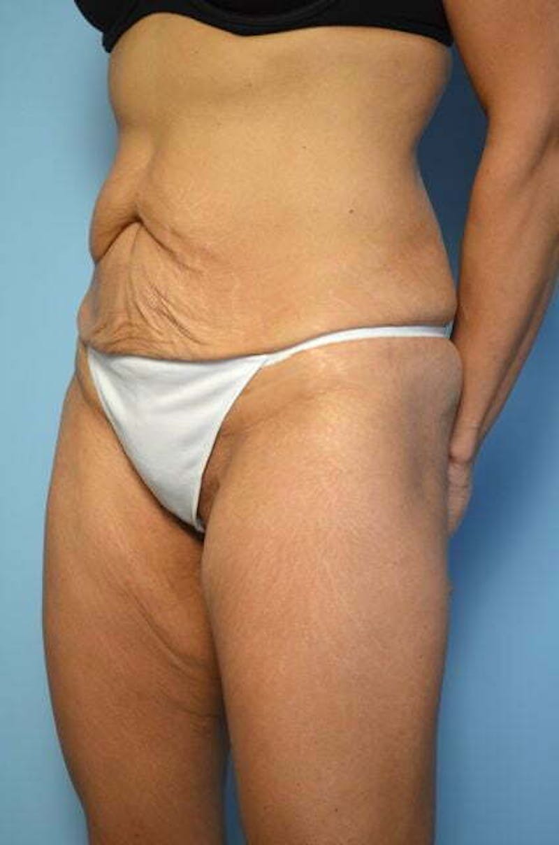 Tummy Tuck Before & After Gallery - Patient 358816 - Image 7