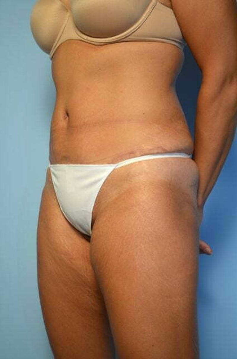 Tummy Tuck Before & After Gallery - Patient 358816 - Image 8