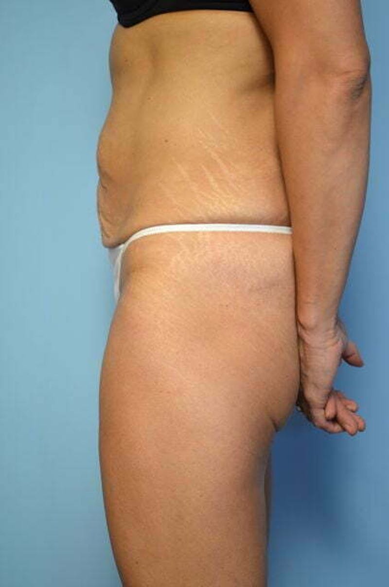 Tummy Tuck Before & After Gallery - Patient 358816 - Image 9
