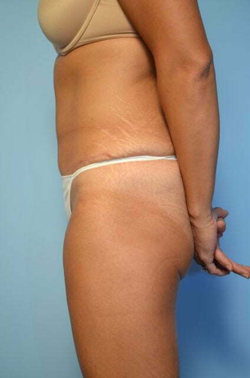 Tummy Tuck Before & After Gallery - Patient 358816 - Image 10