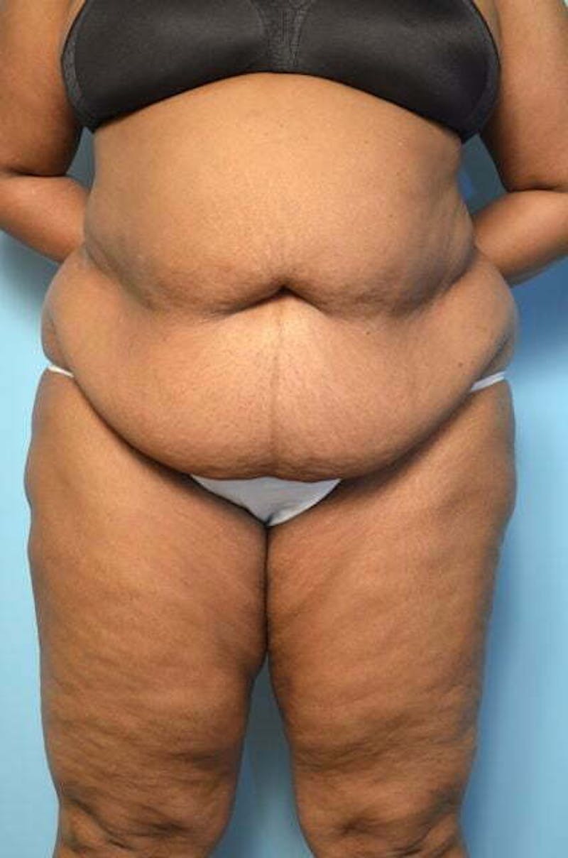 Liposuction Before & After Gallery - Patient 425554 - Image 1