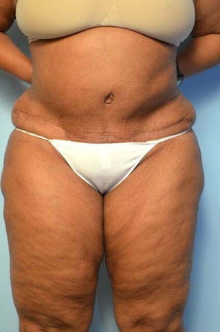 Tummy Tuck Before & After Gallery - Patient 745304 - Image 2