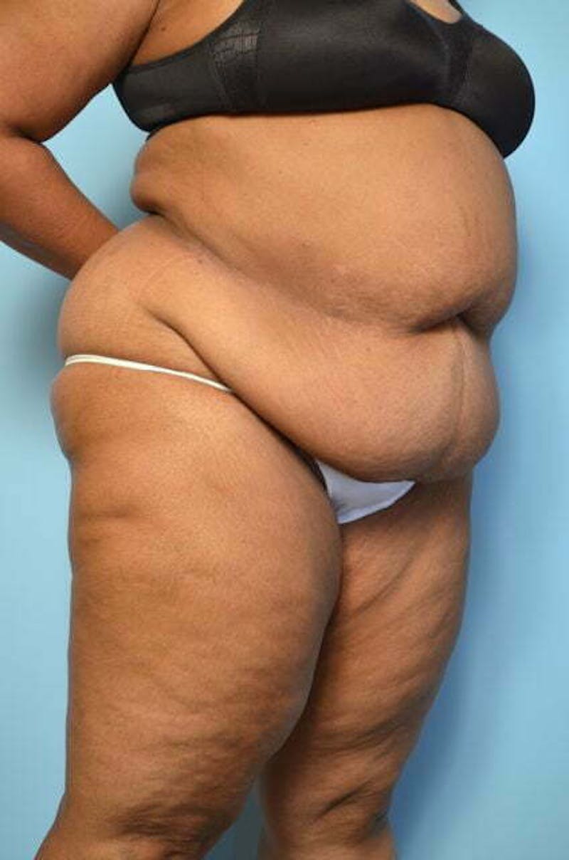 Liposuction Before & After Gallery - Patient 425554 - Image 3