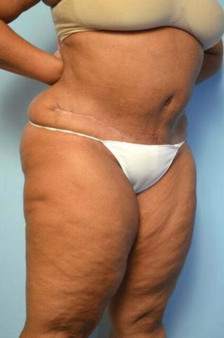 Tummy Tuck Before & After Gallery - Patient 745304 - Image 4