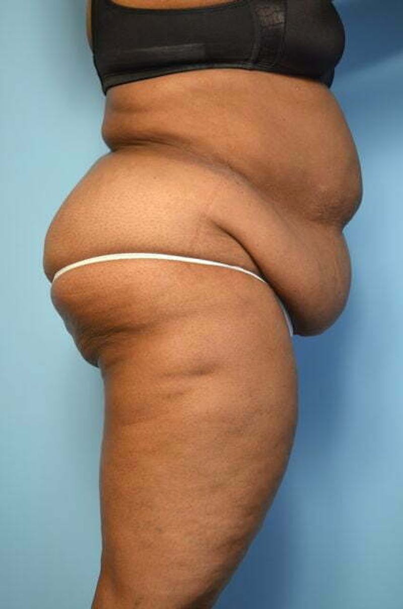 Liposuction Before & After Gallery - Patient 425554 - Image 5