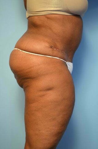 Tummy Tuck Before & After Gallery - Patient 745304 - Image 6