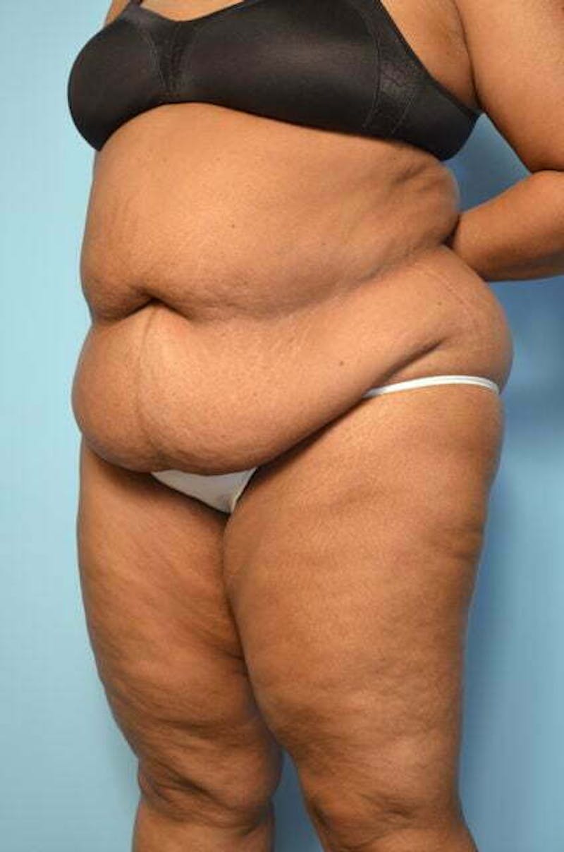 Liposuction Before & After Gallery - Patient 425554 - Image 7