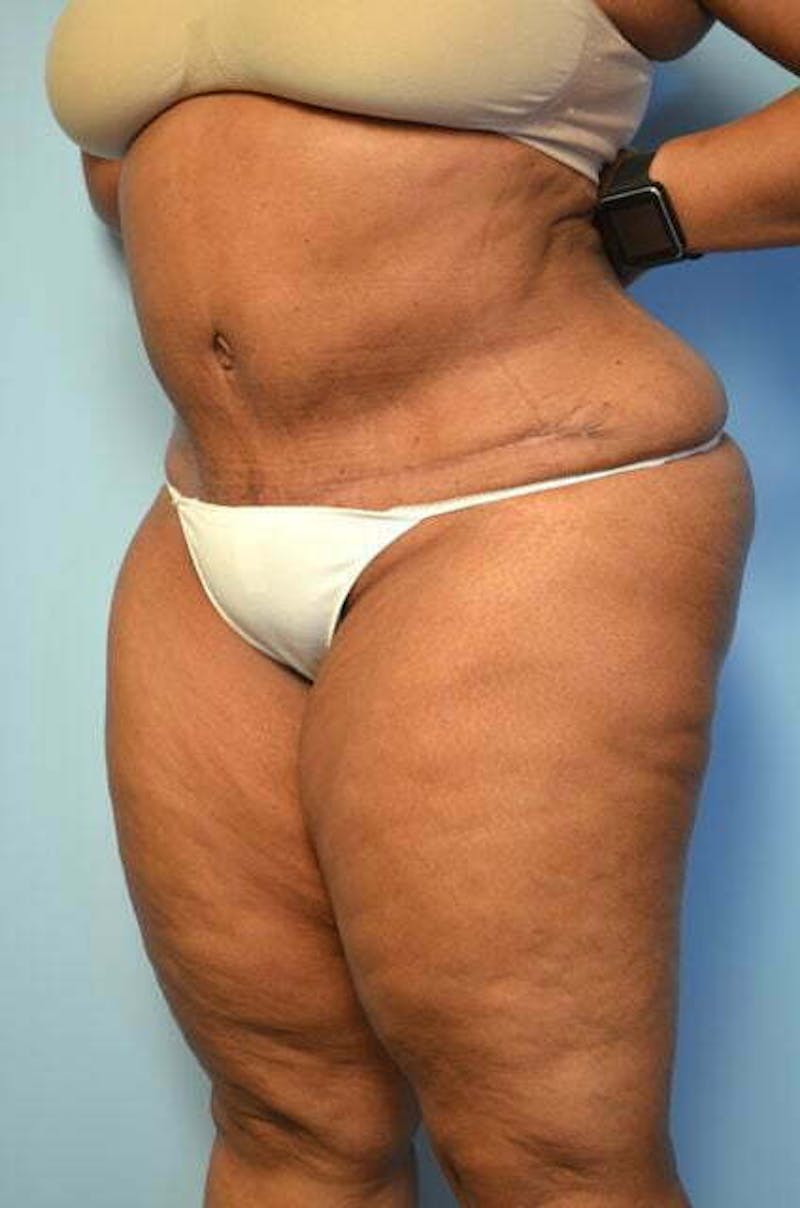 Liposuction Before & After Gallery - Patient 425554 - Image 8